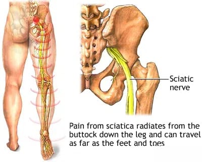sciatic